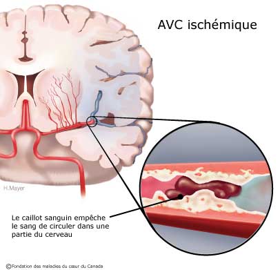 Avc Les Signes Qui Doivent Alerter